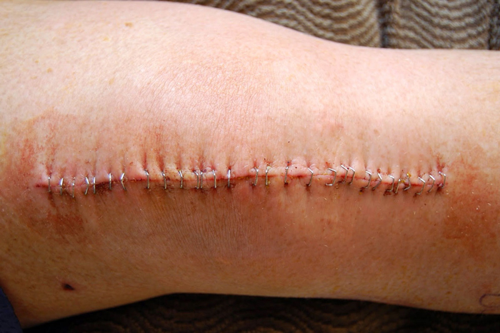 Артроз коленного сустава на какой стадии делают операцию thumbnail