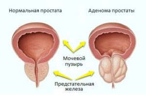 Как проводится операция по удалению аденомы предстательной железы