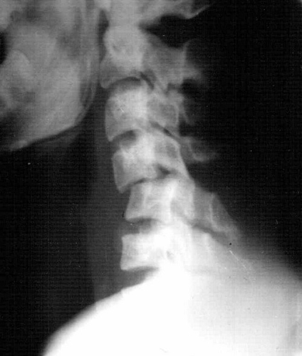 Перелом шеи на рентгеновском снимке
