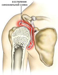 Воспаление синовальной сумки при плечевом остеохондрозе