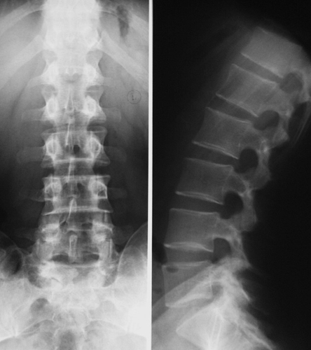 Рентген поясницы при остеохондрозе