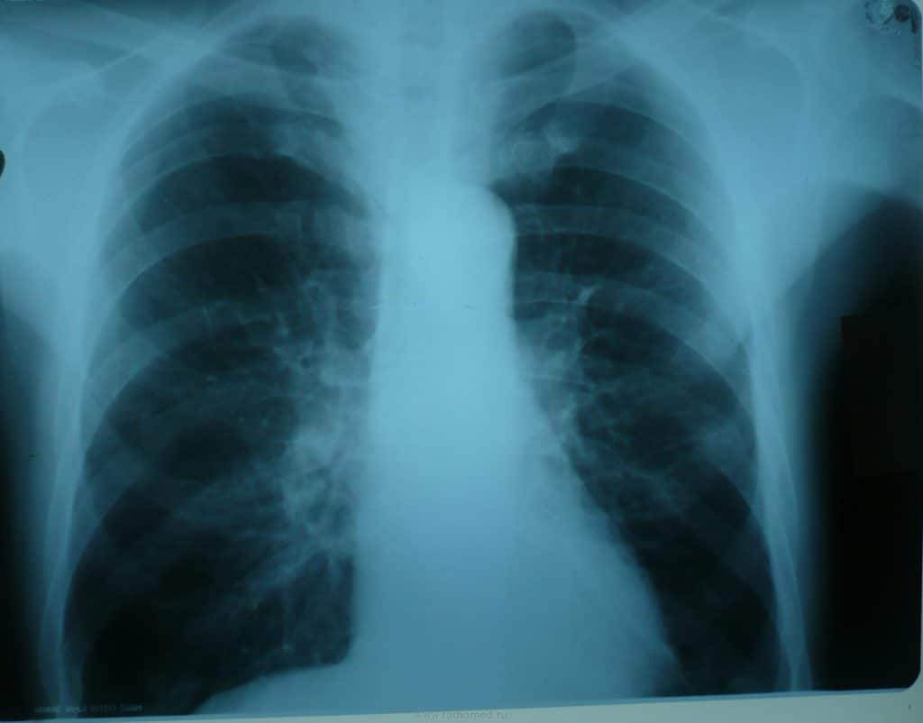 Очаговый туберкулёз