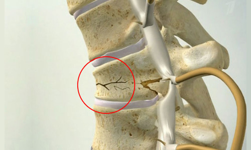 Перелом позвоночника после травмы