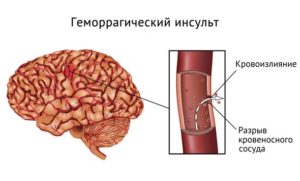 кровоизлияние в мозг и диагностика