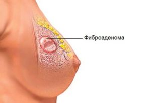 фиброматоз молочной железы