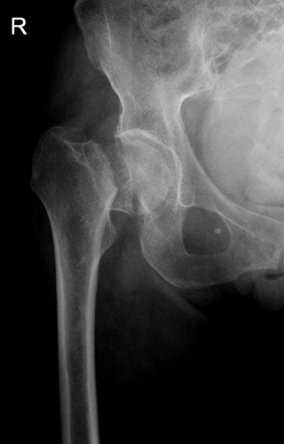 Перелом шейки бедра на рентгеновском снимке