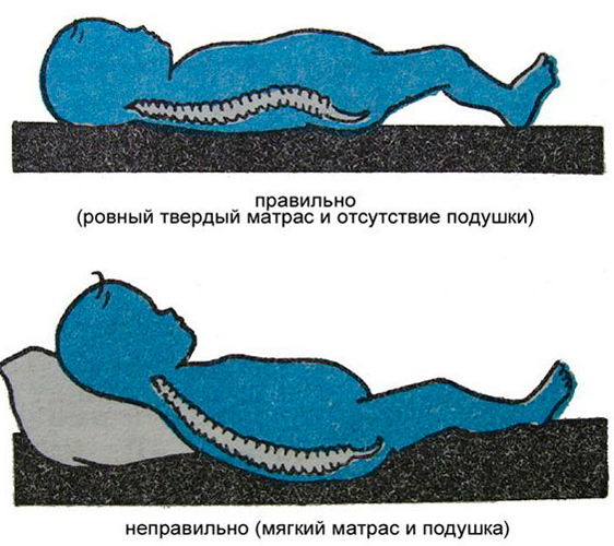 Подбор матраса для лечения сколиоза у ребенка
