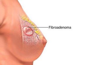 Как диагностируется фиброма груди