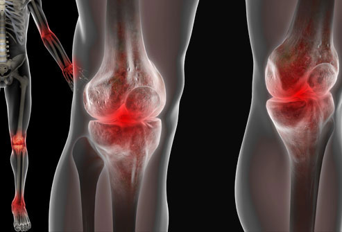 Артропатия коленных суставов