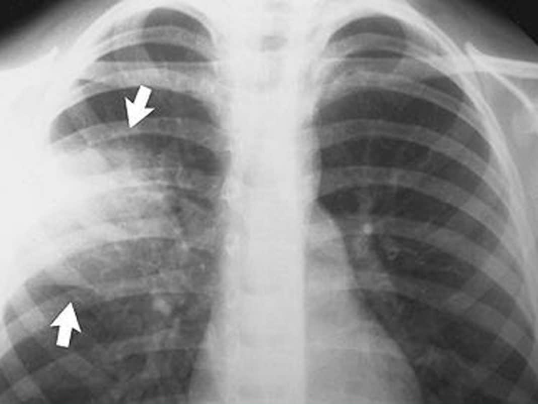 Крупозная пневмония на рентгеновских снимках
