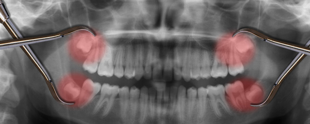 Снимок челюсти с выделенными зубами мудрости