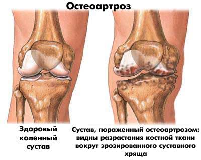 КТ позволяет обнаружить остеоартроз колен