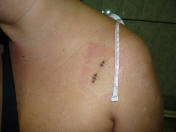 Раны после артроскопии плеча