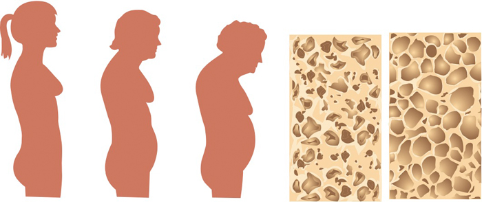 Стадии прогрессирования остеопороза у женщин