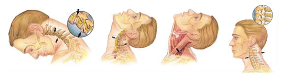 Хлыстовая травма возникает из-за резкого запрокидывания шеи