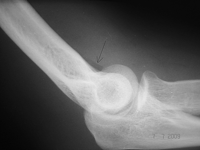 Рентгенодиагностика локтевого сустава и прилегающих к нему костей