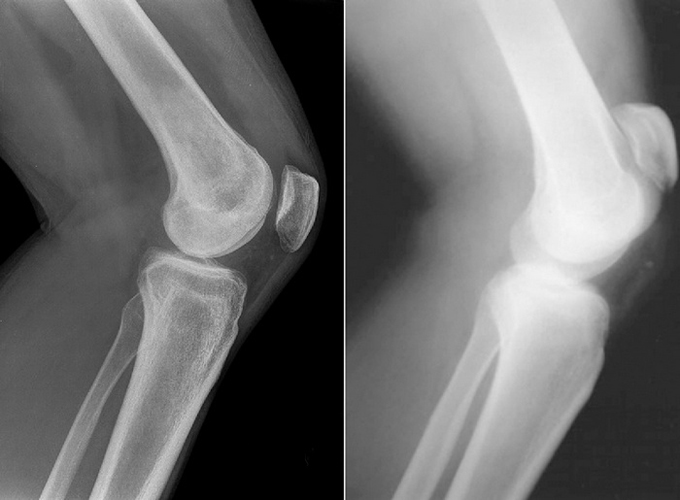 Современная и устаревшая рентгенография коленных суставов