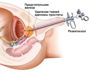 карцинома предстательной железы и лечение