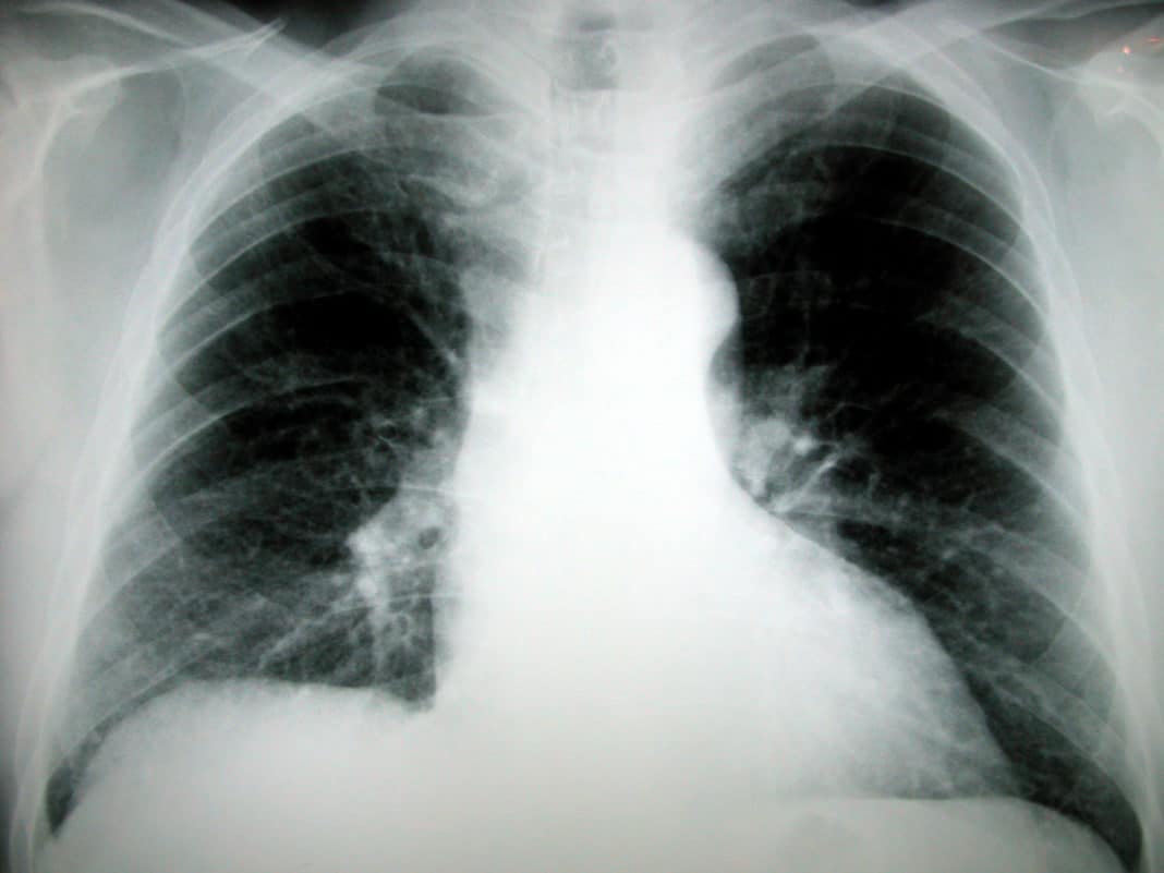 Снимок лёгких перед пневмоэктомией