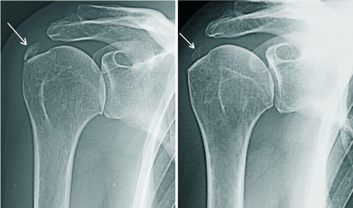Остеопороз плечевого сустава на снимке рентгенографии