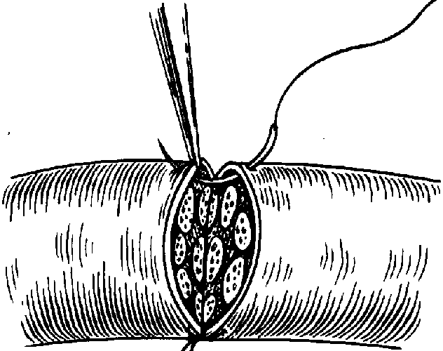 Один из способов сшивания нервов (наиболее популярный способ)