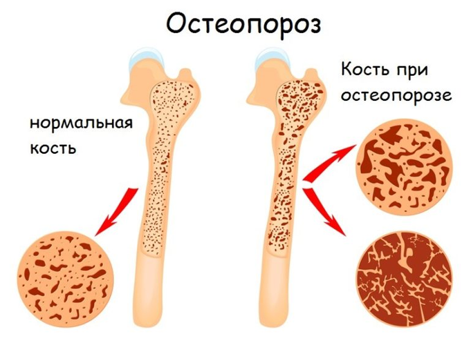 Здоровая и пораженная остеопорозом костная ткань