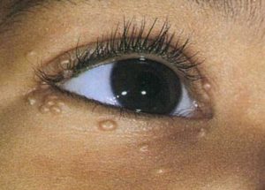 Как лечатся папилломы на глазах