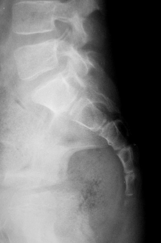 Диагностику перелома крестца проводят с помощью МРТ, КТ или рентгена