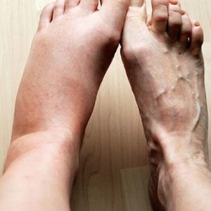 Почему может появиться опухоль на ноге и лечение