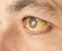 Желтые белки глаз