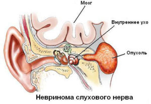 невринома слухового нерва
