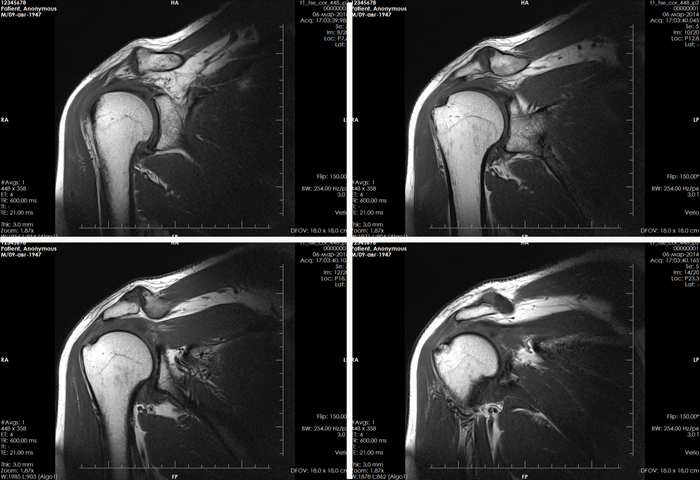 Серия МРТ снимков плечевого сустава