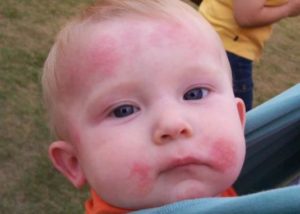 При аллергии препарат противопоказан ребенку