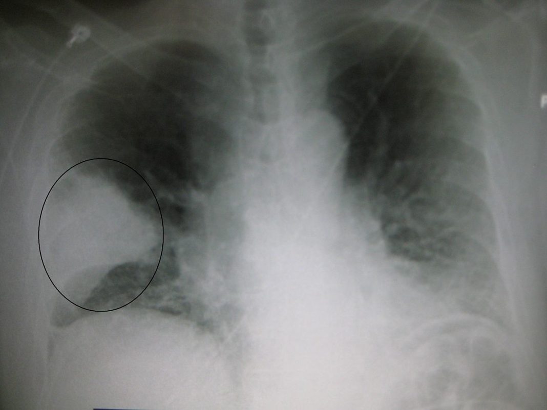 Очаговая пневмония на рентгене