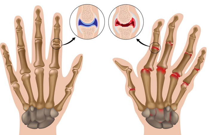 Плаквенил можно применять при нескольких видах артрита