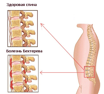 Здоровая и пораженная болезнью Бехтерева спина