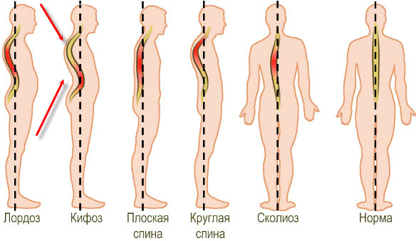 Патологический кифоз кардинально различается от других болезней спины, опытный врач никогда не спутает его с другим диагнозом
