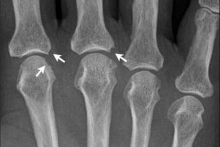 Патологические изменения при артрите суставов пальцев рук