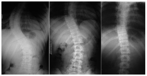 Рентгеновский снимок сколиоза позвоночника