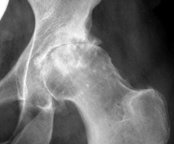 Рентгенография при остеопорозе тазобедренных суставов
