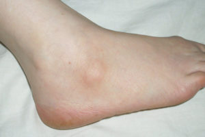 Меры диагностики и лечение фибромы на ноге