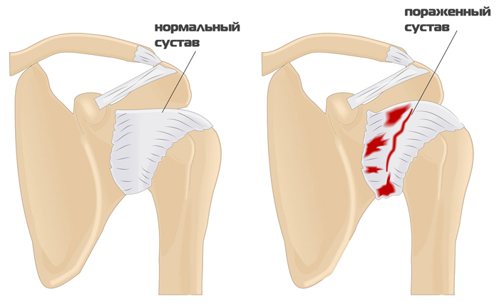 Нормальный и пораженный остеопорозом сустав плеча
