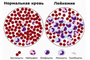 миеломы крови