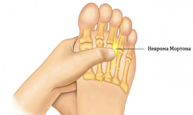 Болит нога возле пальцев. Невринома Мортона стопы. Синдром Мортона неврома Мортона.