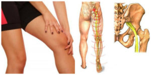 Симптомы и лечение защемления нерва в ноге