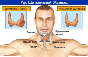 карцинома щитовидной железы