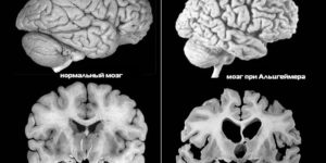 Основные признаки болезни Альцгеймера на ранней стадии
