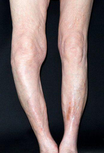 Деформация ног при болезни Педжета