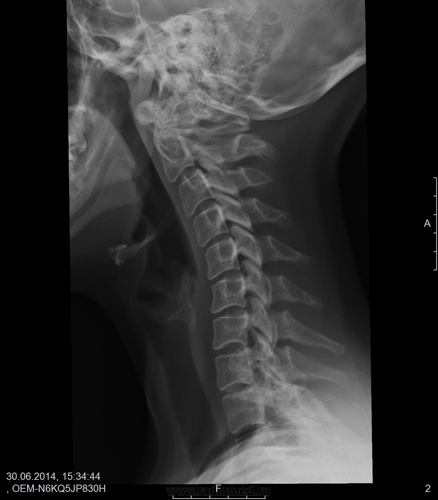 Рентгеновский снимок кифоза шейного отдела