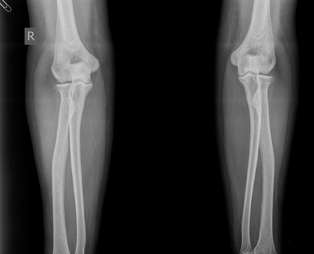 Рентгенография прекрасно визуализирует костную ткань